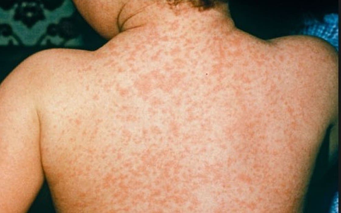 Ova država bilježi najgoru epidemiju ospica u 35 godina: Procijepljenost ponegdje pala na samo 20 posto